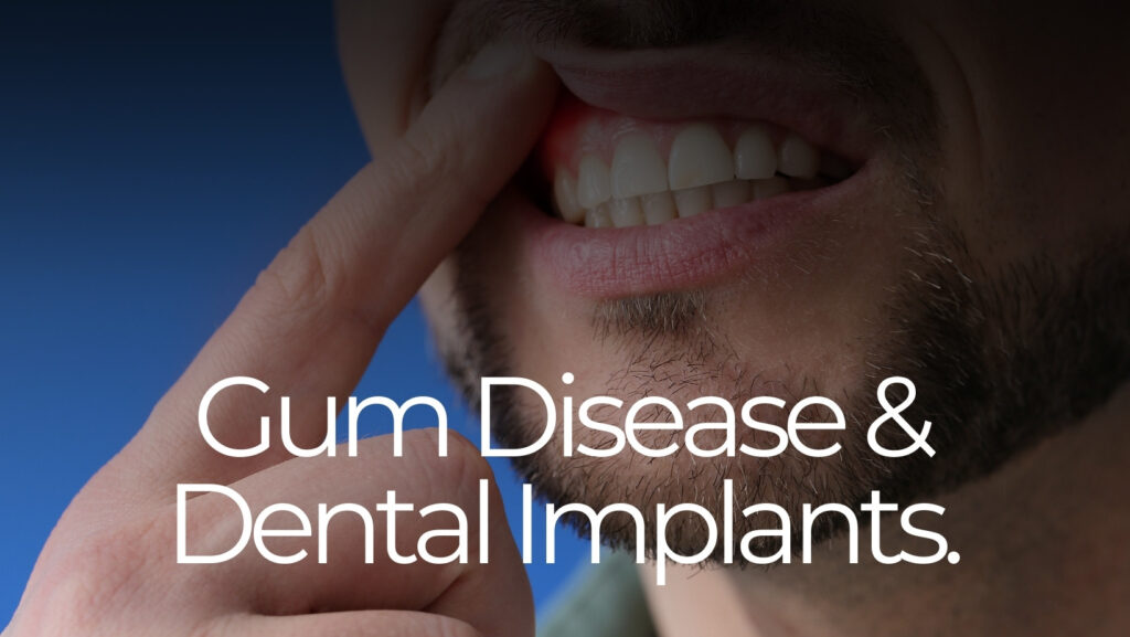 Can you have dental implants with gum disease