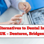 Top Alternatives to Dental Implants in the UK – Dentures, Bridges & More